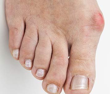 Bunion