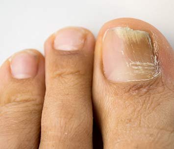 Fungal Nail Infection