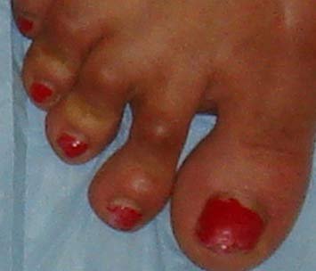 Hammertoe