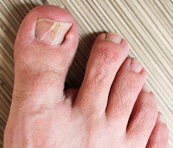 Ingrown Nail