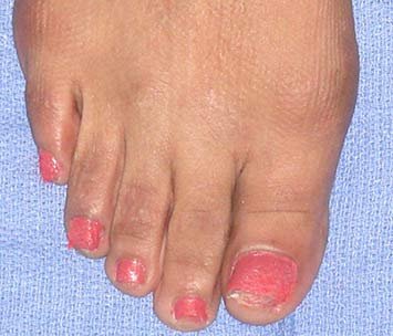 Long Second Toe